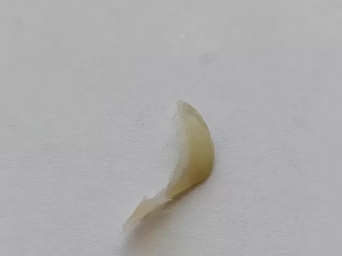 Ingrown Nail Removed , the softest most gentle approach I can do, took me three hours, hope there shall be no puss, or cysts, by Tangent_Virtual_Cars