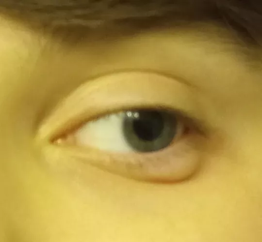 is this a stye? it appeared extremely suddenly, like within an hour or two by awkwarderest