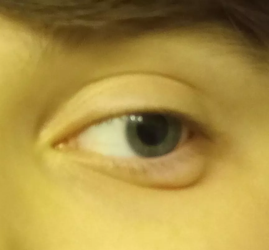 is this a stye? it appeared extremely suddenly, like within an hour or two posted by awkwarderest