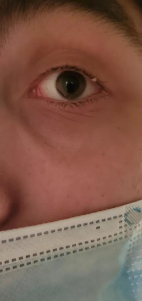is this a stye? I've had it for 3 weeks now and it's never been painful and it never grew more than this size. by SamDaGoat34