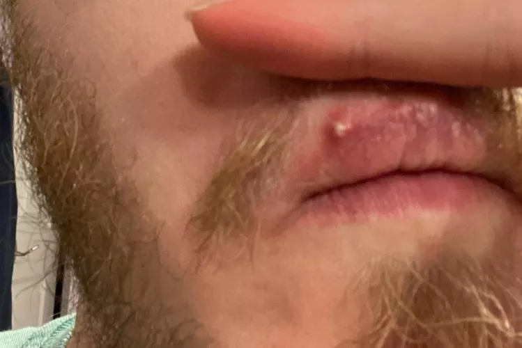 It popped on its own. He wouldn't let me touch it 😭 by RowanMerrickJones