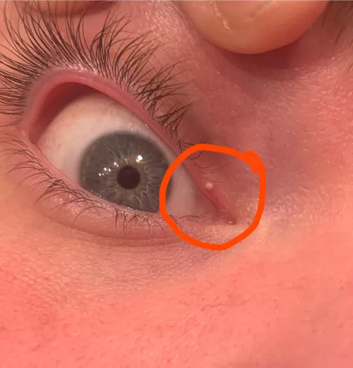 I’ve had this on my eye for over two years now. Do I pop it or leave it? What exactly is it? by FamShepMan