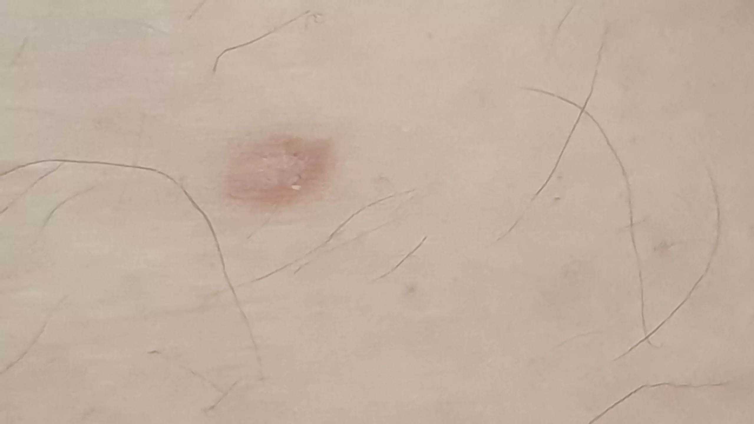 I've had this on my inner thigh for years, its hard as a rock and looks 