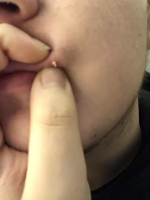 Just got this bastard out and it hurt like hell by Whatyallthinkofbeans