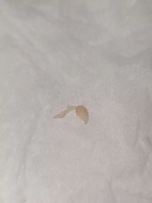 Just popped this on my chest after it botherd me for weeks now. Its quite hard tissue, what do you think it is? by kabaclanlarry
