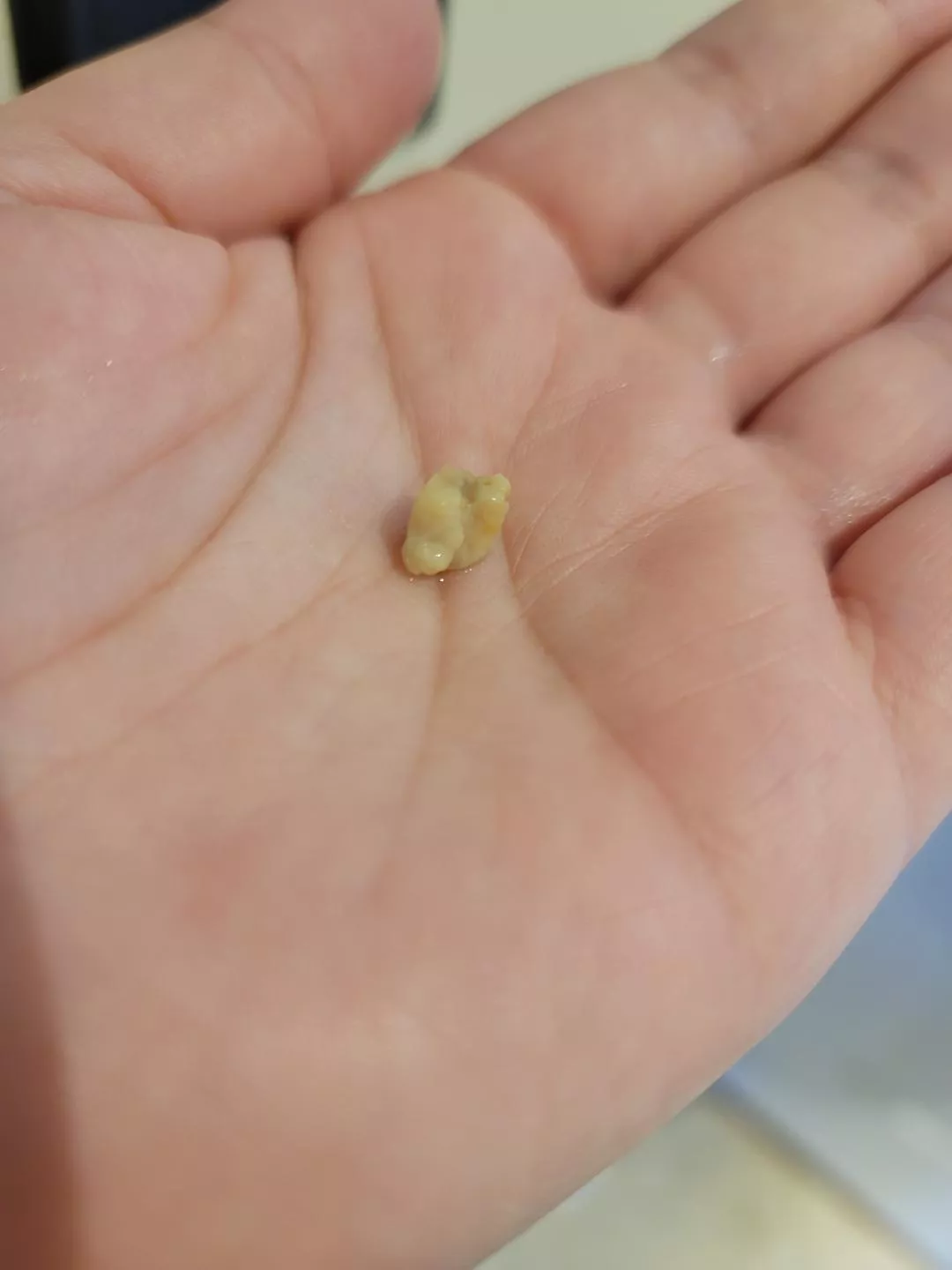 large tonsil stone while brushing my teeth posted by macedonian_mama