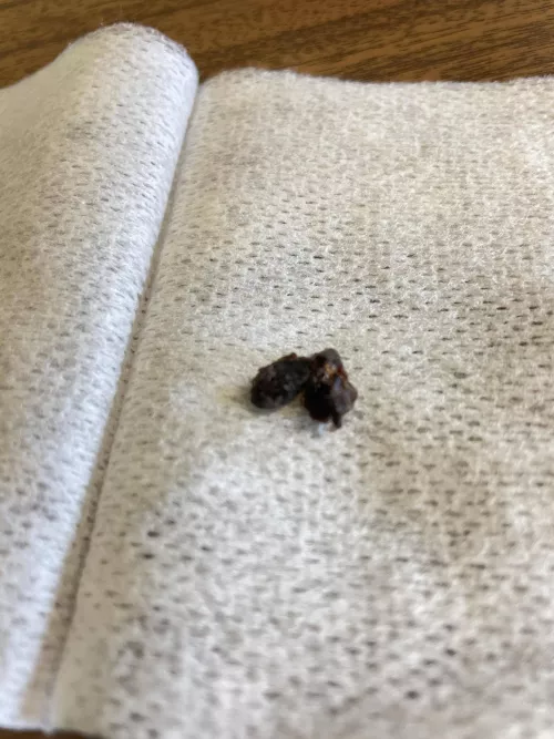 Left hear wax, not as good as the right one but now I can listen to colours in 8k surround. by LaBombonera