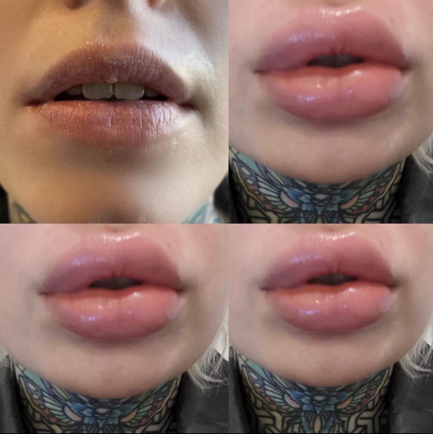 loving my lips this time around. Before and after 😘 posted by SindySchism666