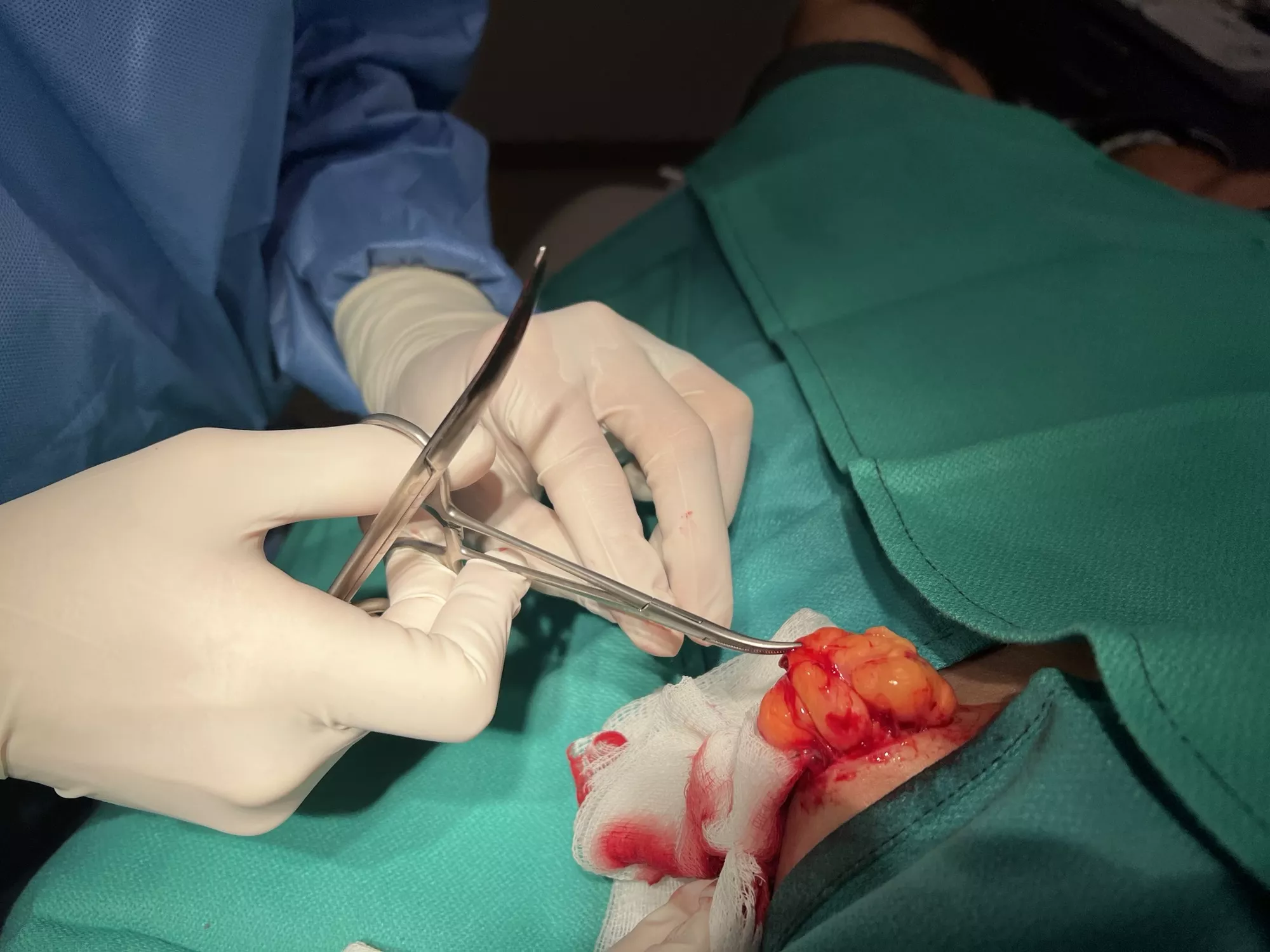 Lymphoma removed from my side posted by bobbydillon22