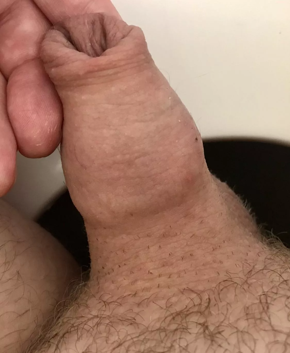 Making great progress with foreskin restoration. 3.5 years next month but very much worth it. posted by trueplankton103