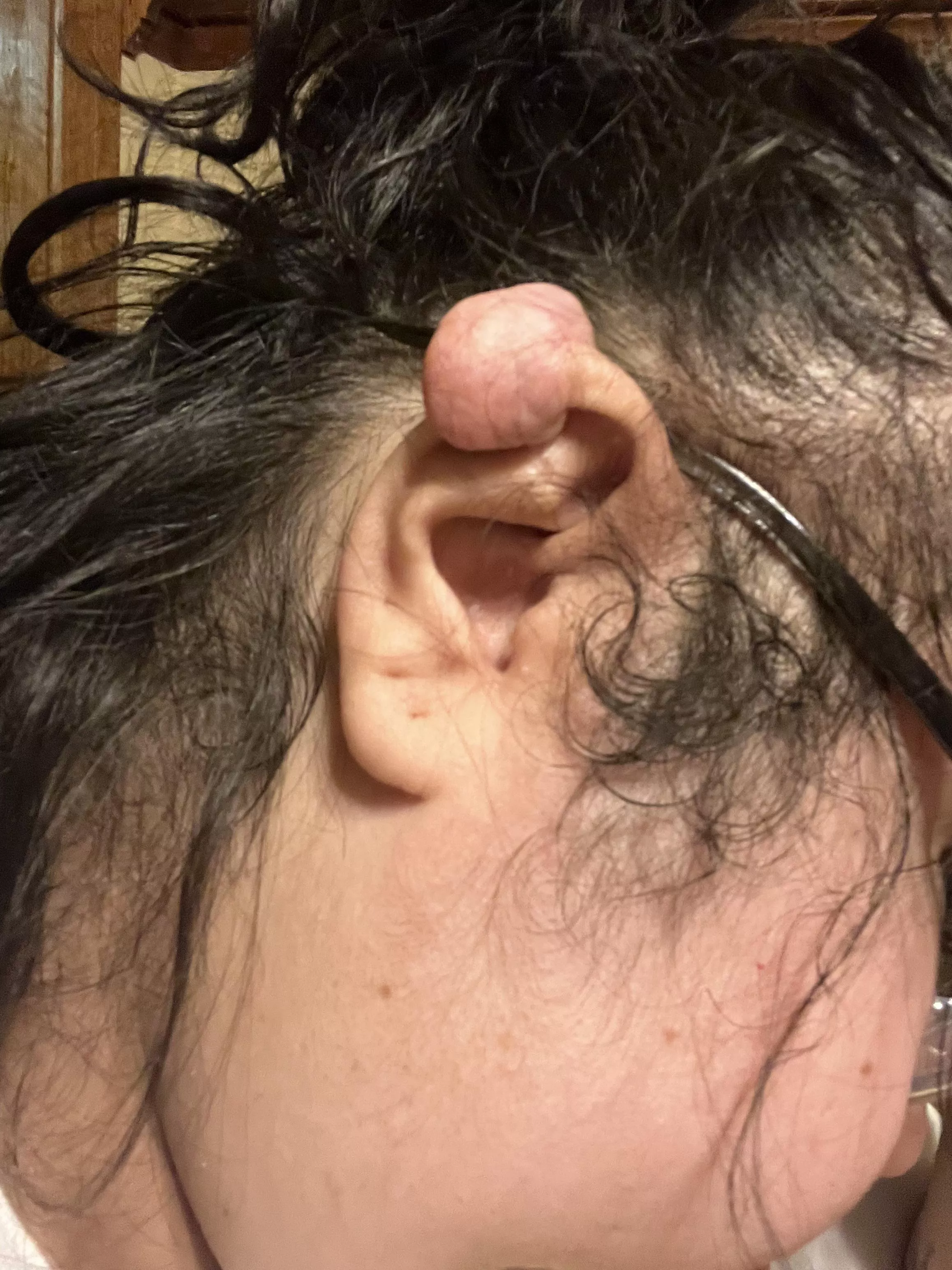 Meet the keloid that refuses to leave!! I’ve had my ear operated on 3 different times to get rid of it. The last time I got it removed the surgeon said this was the last time he’d do it because I obviously wasn’t taking care of my self. posted by NekoMiladyNoir