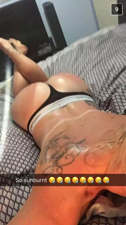 More sunburn by Born-Sheepherder-709