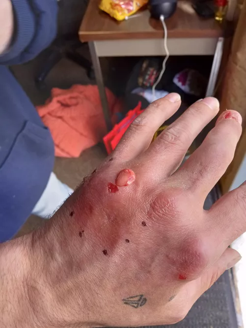 MRCA another infection going back to see my surgeon by Extension_Pianist779