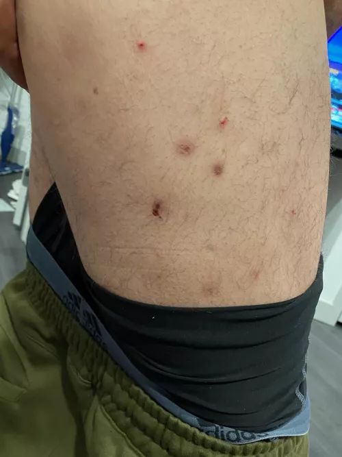 my crps blisters. They usually have a hard core in the middle. by HighRevGoji