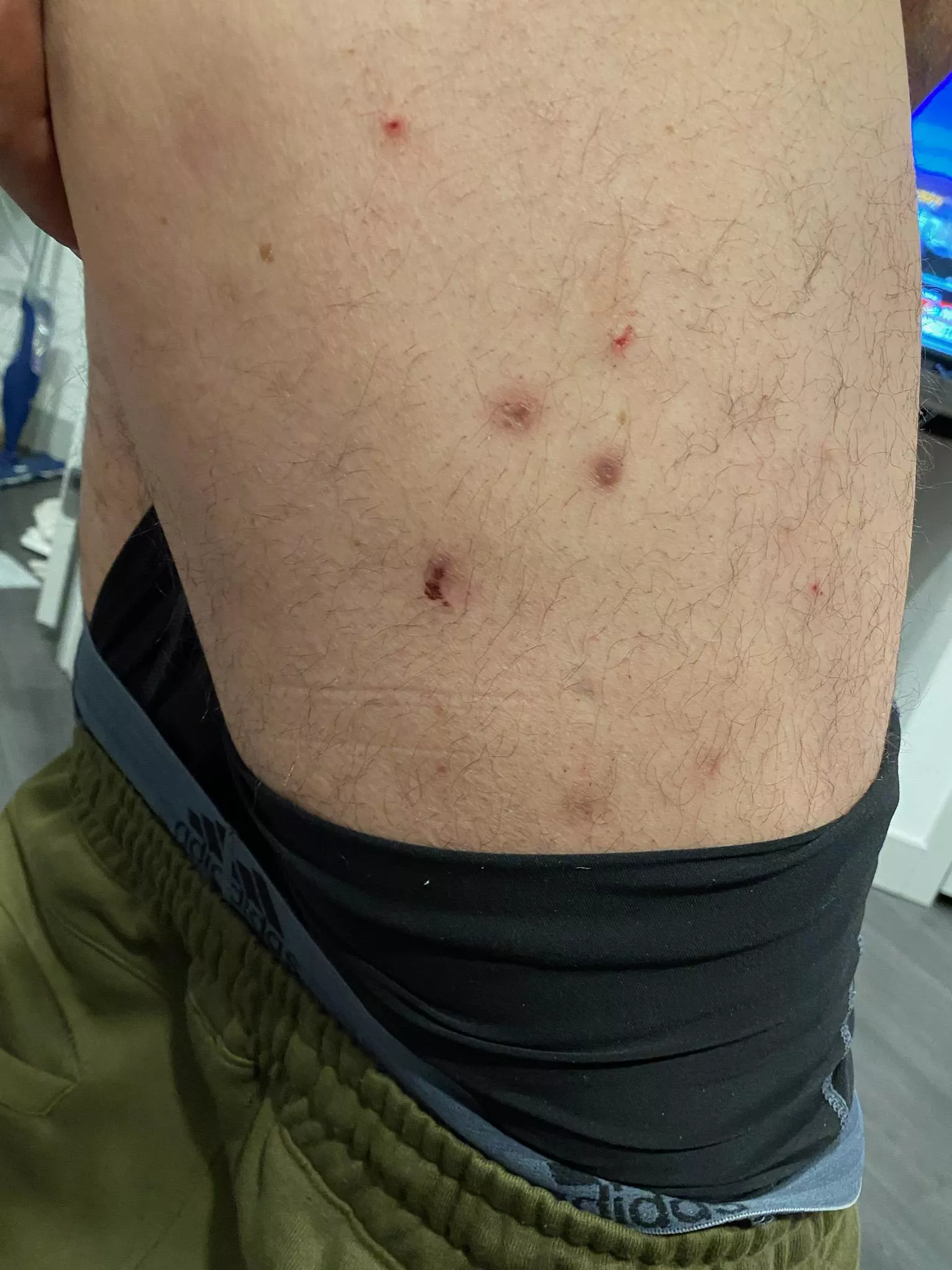 my crps blisters. They usually have a hard core in the middle. posted by HighRevGoji