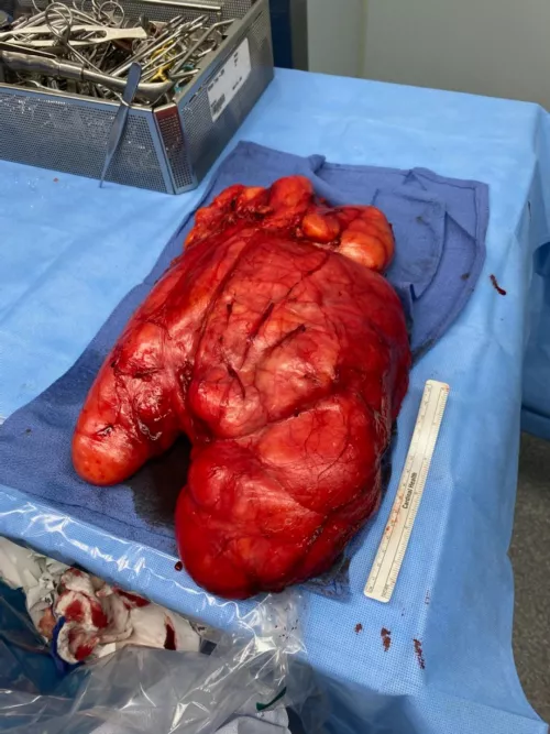 My Dads 13lb Lipoma taken from his leg in 2020. It was benign and he's able to walk like normal! by xXMewRoseXx