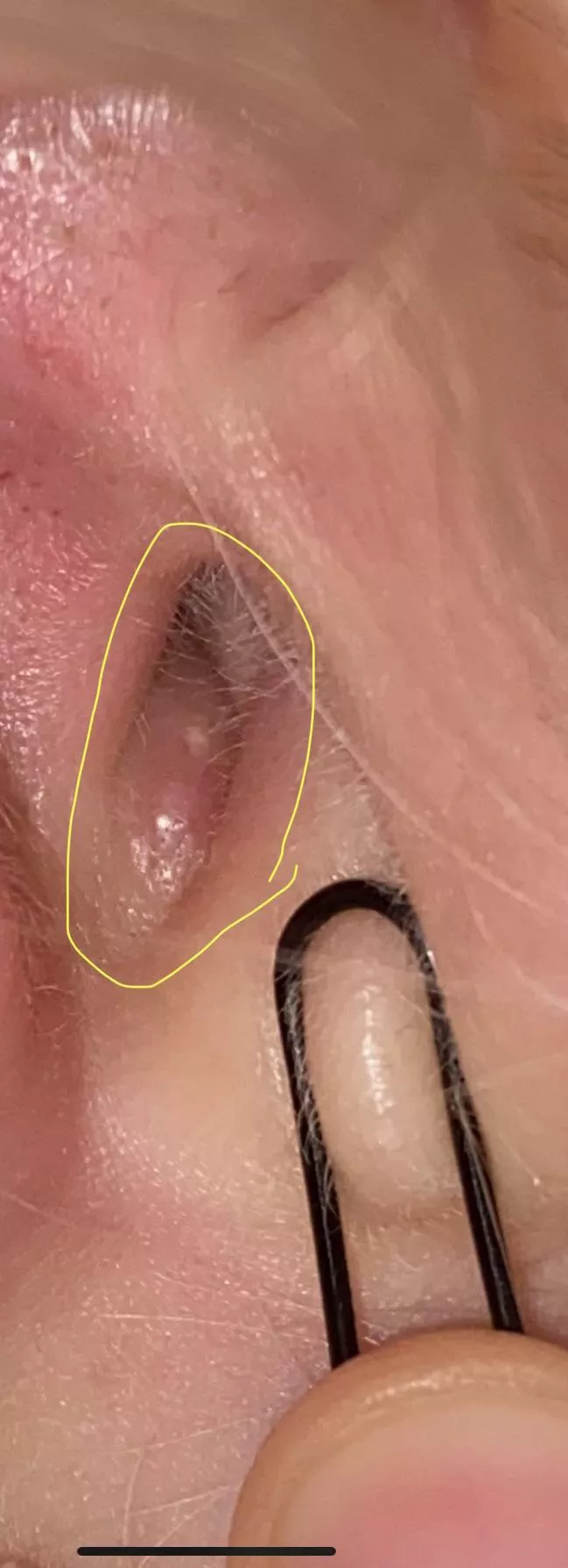 My ear. Not a video but this must be one of the worst places to get pimples. It hurts so bad to squeeze it I can’t get it out 😭 just straight up sitting in my ear canal posted by bauil
