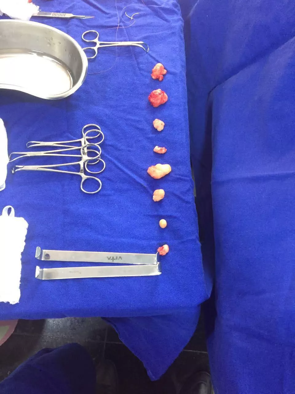 My little buddies removed from my right arm posted by renke0