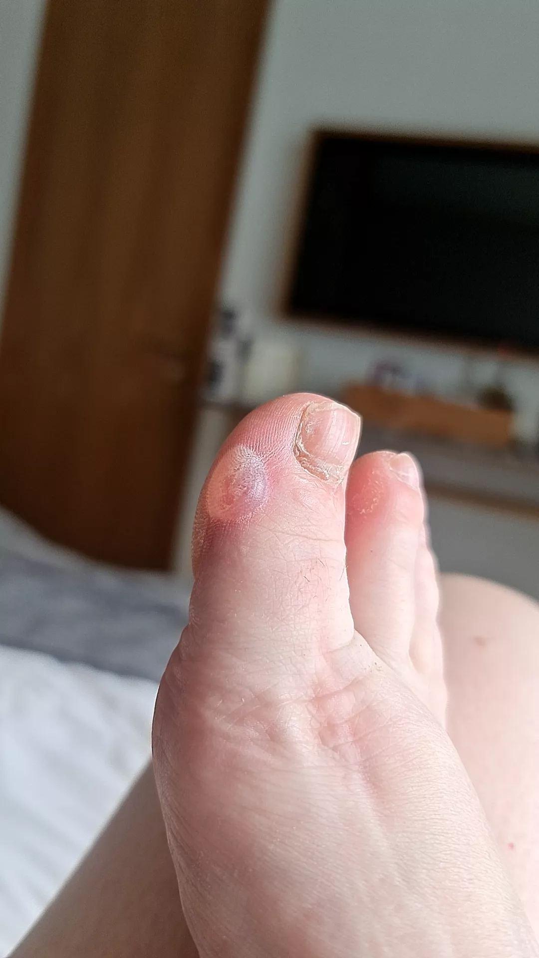 My own rather sore forbidden pop :( posted by Littleleicesterfoxy