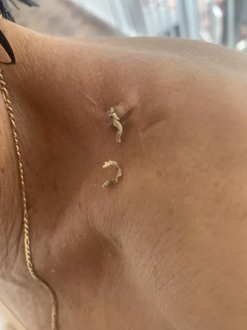 My wife, who hates that i am a lurker on r/popping, let me post a pic of what she squeezed from her mom by ward2nite