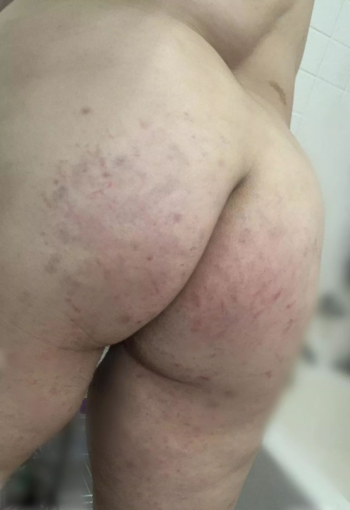 Next day bruises posted by l8nite_doublefeeture