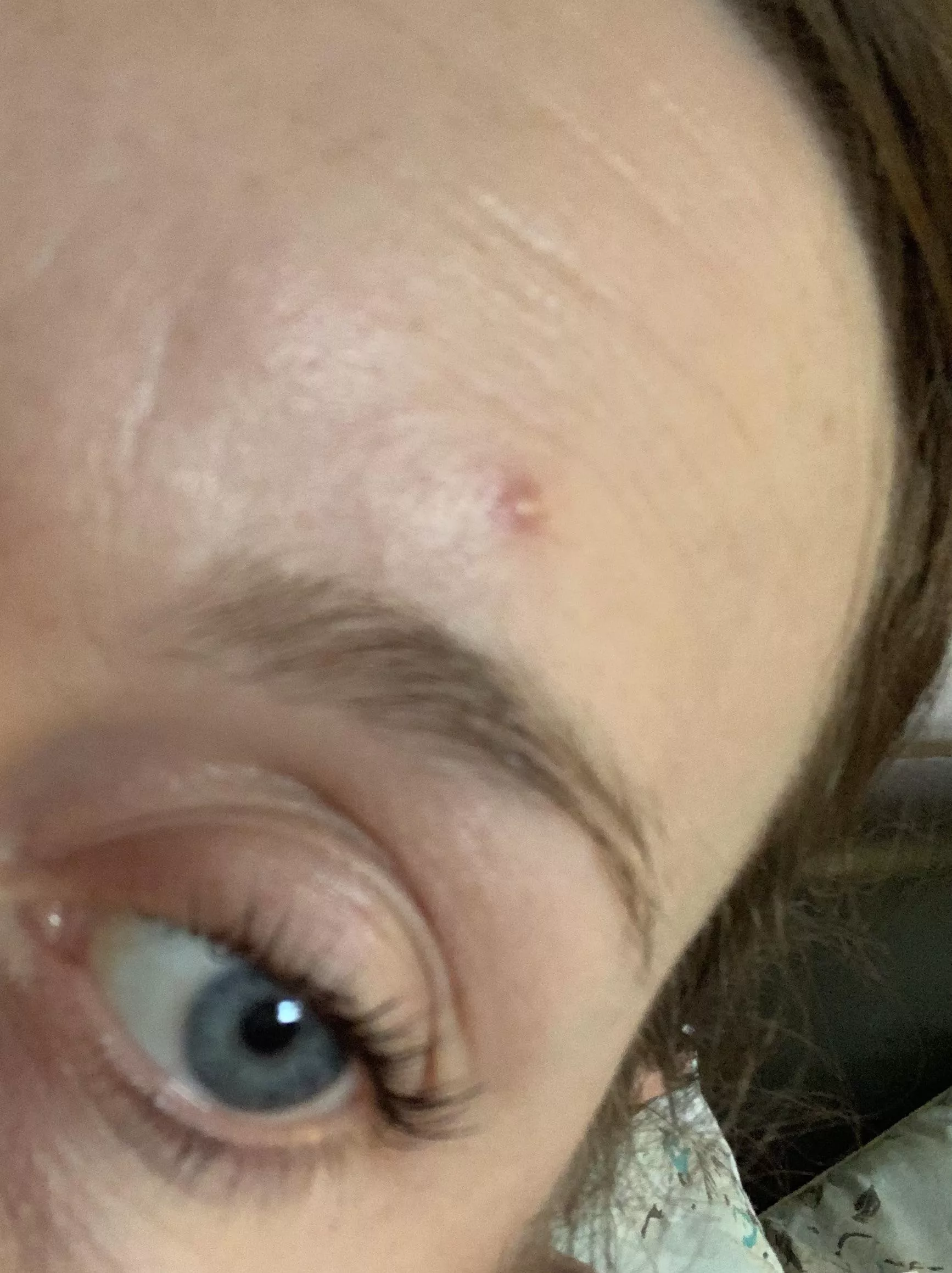 Not shifting after a week-best way to pop without leaving a mark? posted by archercam