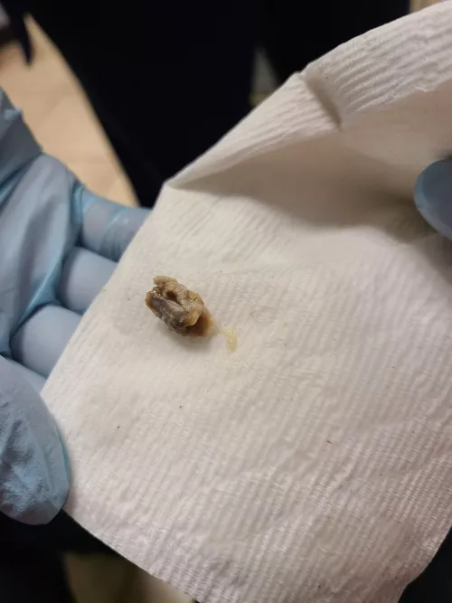 Not sure if this is the right place for this, but they pulled this out of my ear doing a lavage today. by clowens1357