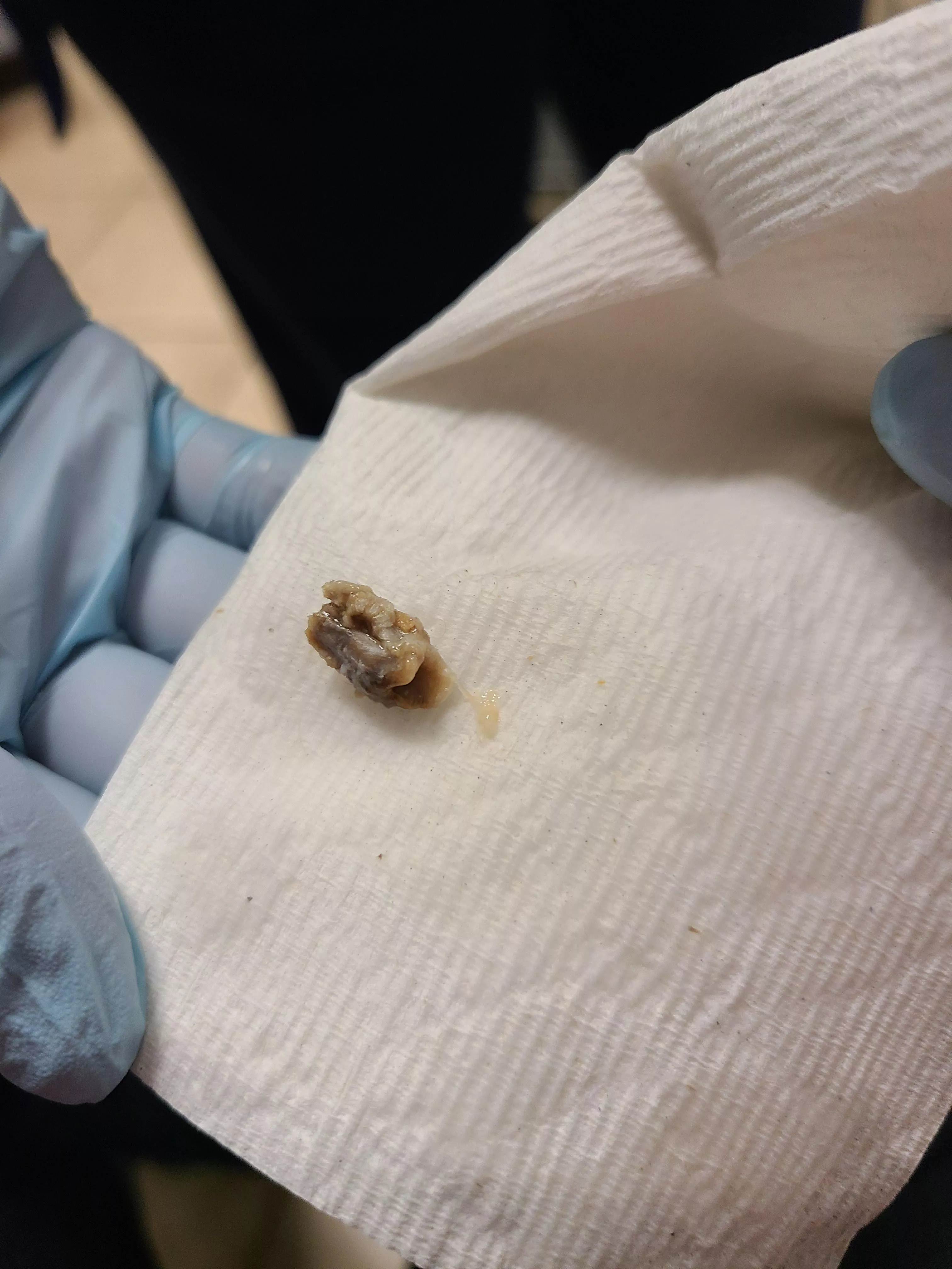 Not sure if this is the right place for this, but they pulled this out of my ear doing a lavage today. posted by clowens1357