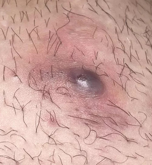 not sure what to do about this.. used warm compress and now looks like its ready to blow by undsme