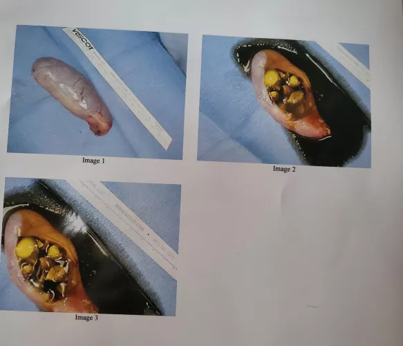 Not your average pop: Got my gallbladder taken out today and had my surgeon disect it to show me, she was ready to bust! by skyegawn