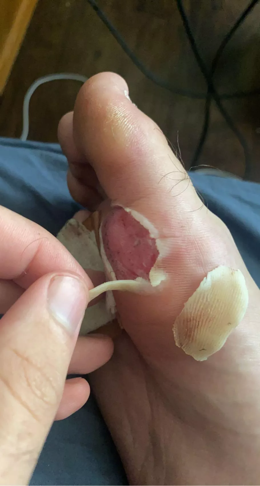 Nothing popped, just your friendly neighborhood blister gone wrong 😂😭 posted by Jacob517