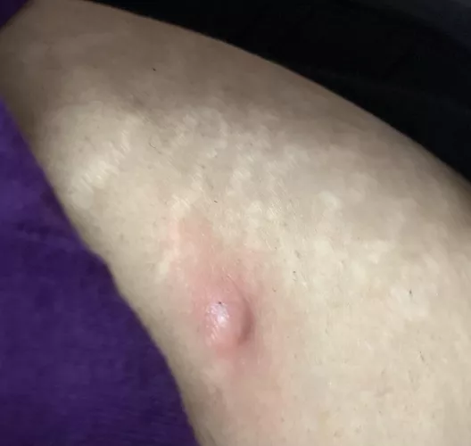 Noticed this weird looking thing on my hip today. Hurts when you press it. Don’t know what it is. by Overthinkeraf