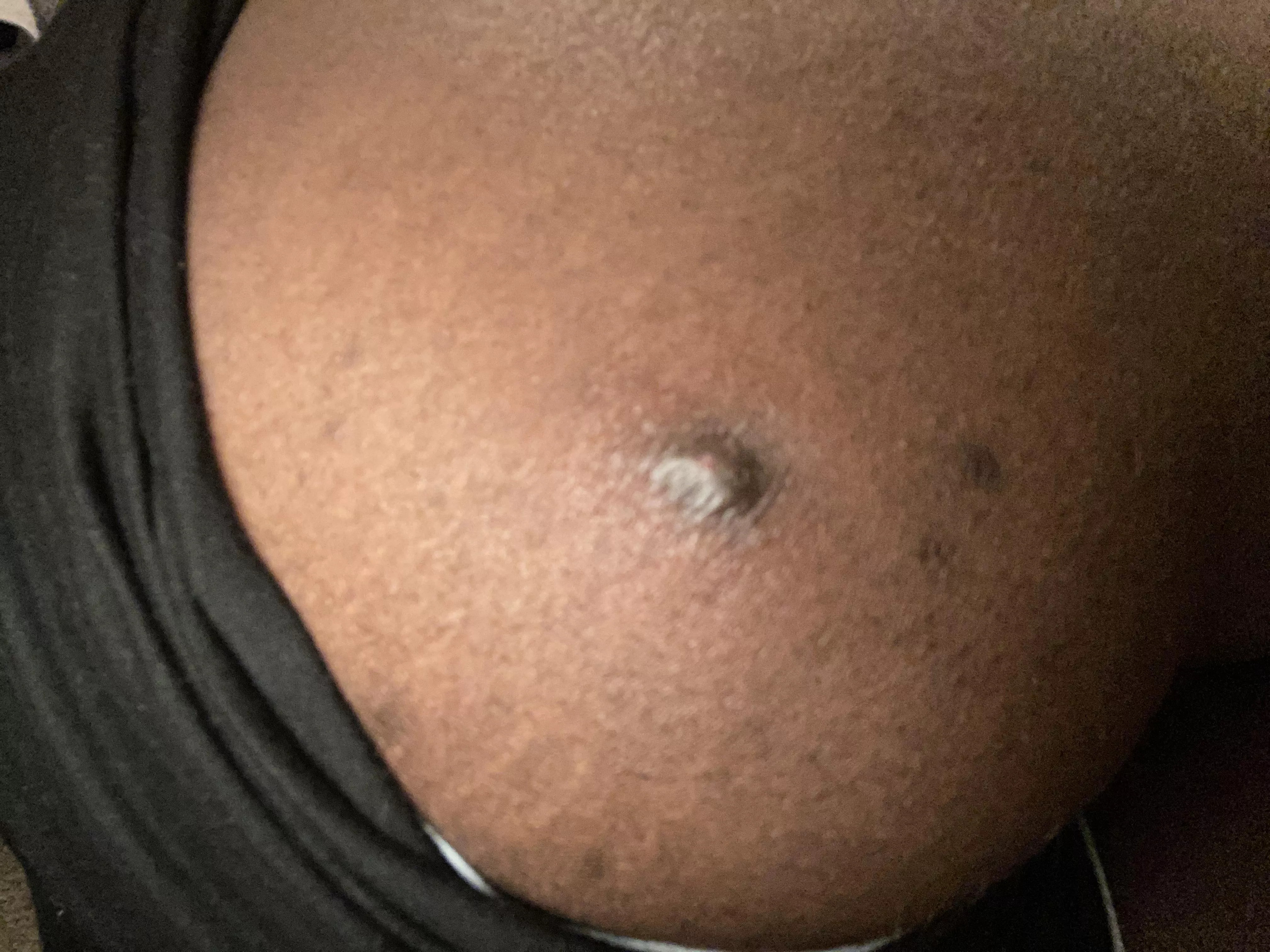 Nsfw for location. But this has been on my butt cheek for a week now and it hurts so bad (even when I lay down). Cant wait to get this to a head posted by Kaz_Stein