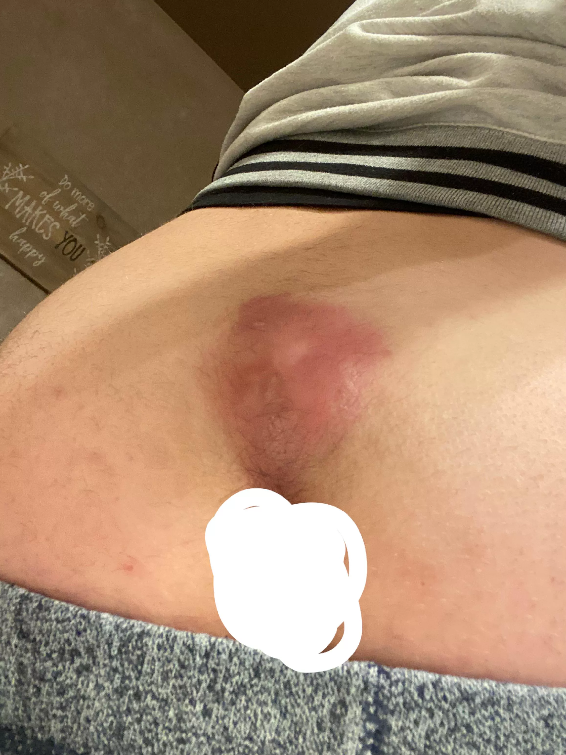 (NSFW) Just had this massive pilondial dealt with today. Safe to say my problems are behind me now. posted by roachieboii