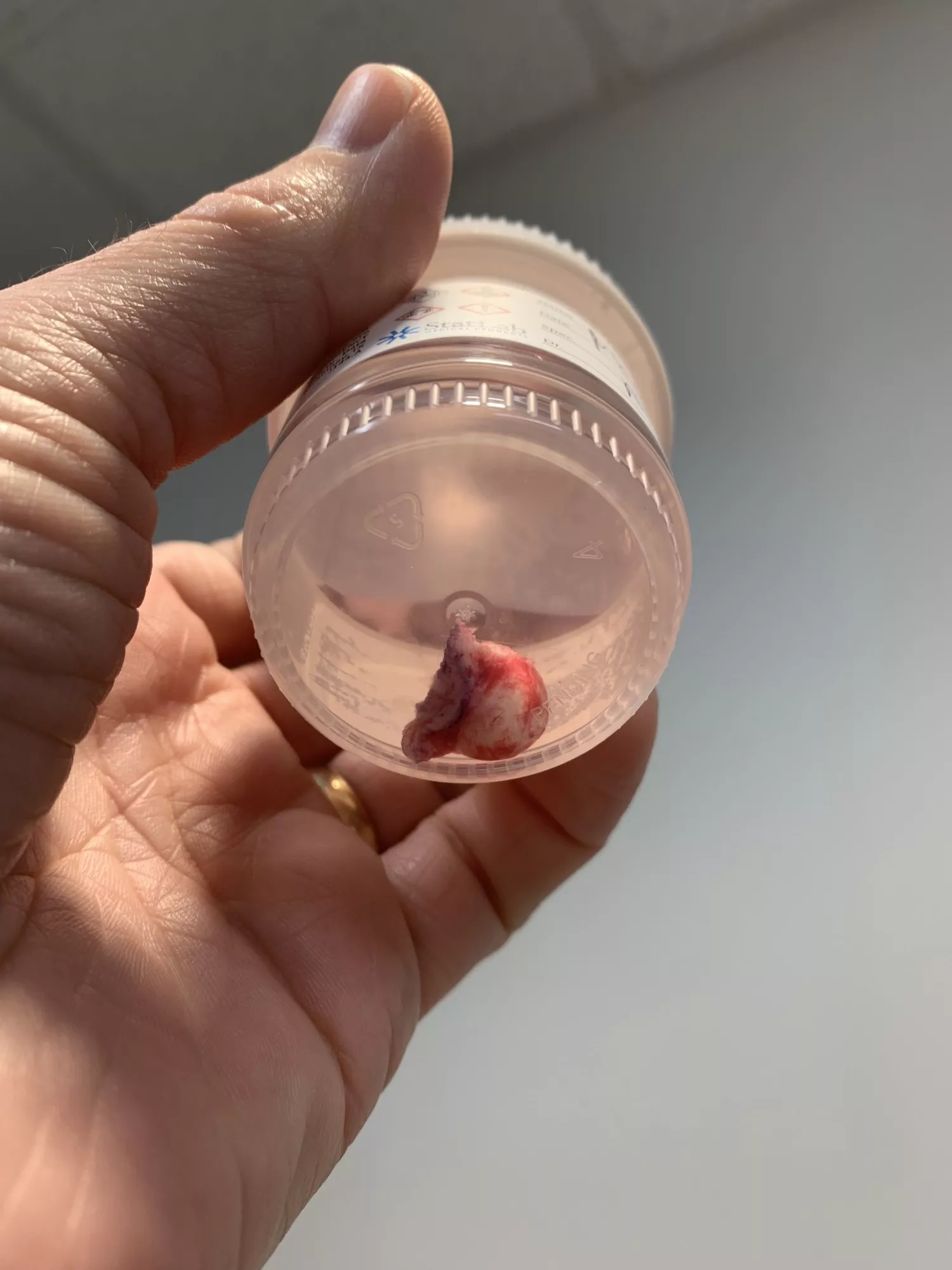 [PIC] Of a Cyst I had removed from my shoulder. Slightly larger than a marble, we thought it would be pea sized. One more off my spine in two weeks. posted by ddrt