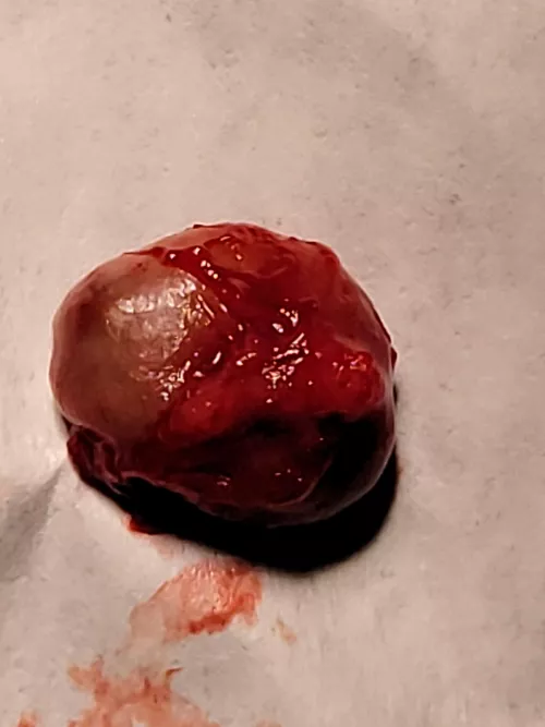 Pilar cyst fresh off my scalp today. Dr wouldn't let me record the procedure. Barely over 1cm by Jackflack42