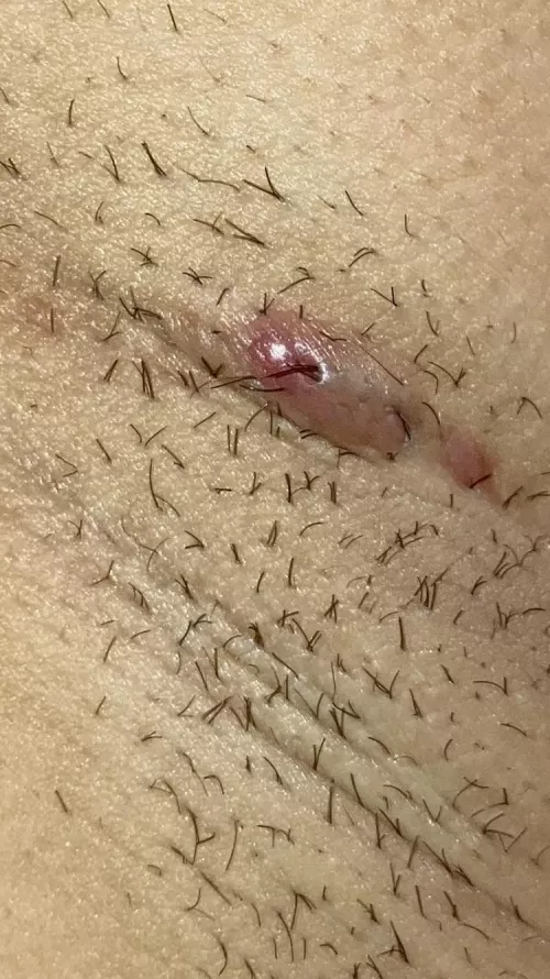 Pili multigemini and follicular cyst? by madjerz23