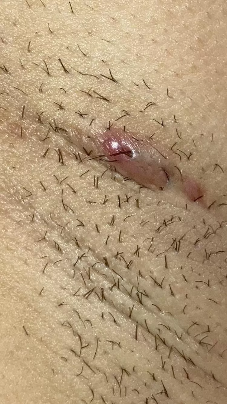 Pili multigemini and follicular cyst? posted by madjerz23