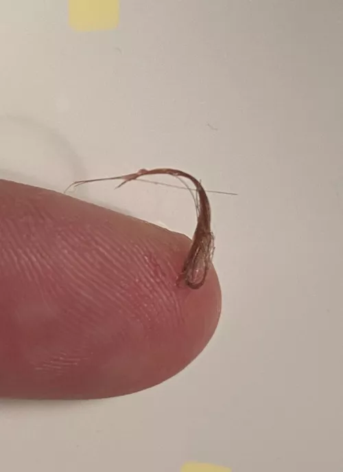 Pilonidal Cyst Contents by RutherfordBWho