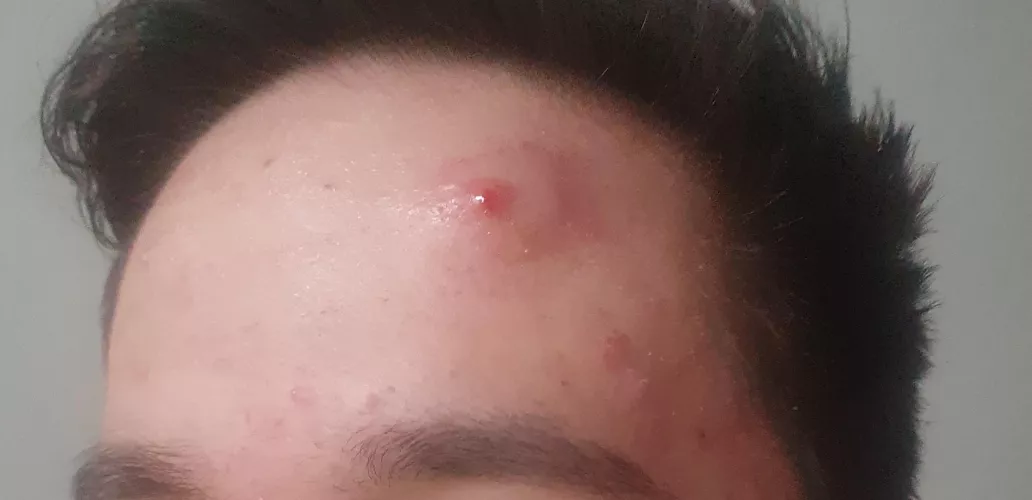 Popped a big pimple and now theres a huge bump around it, any advice and answers what to do? by dehsoowtogu