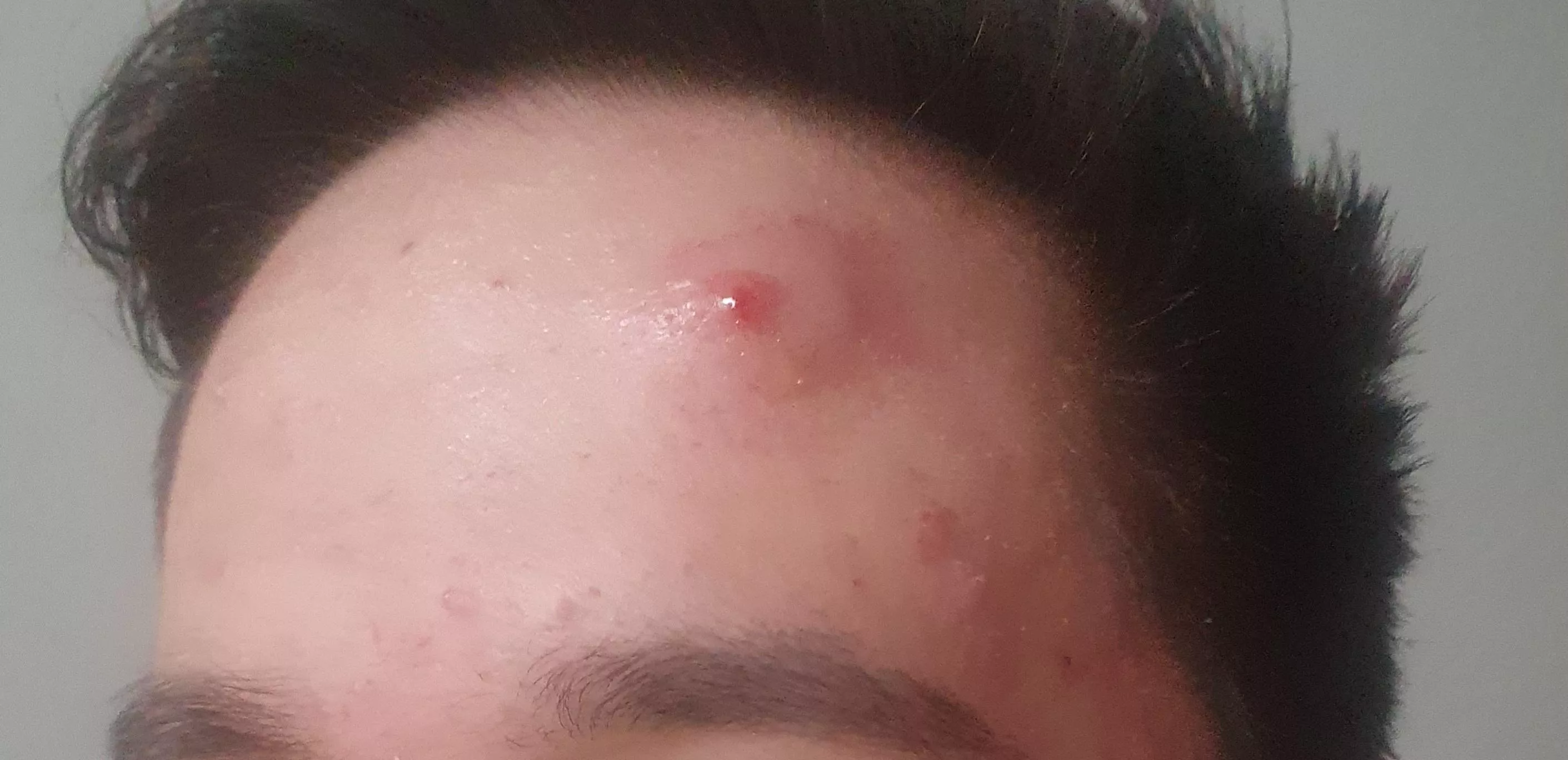 Popped a big pimple and now theres a huge bump around it, any advice and answers what to do? posted by dehsoowtogu