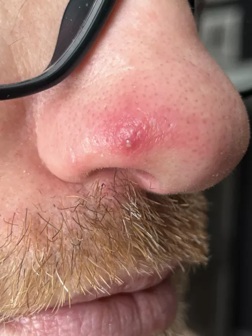 Popped this on my husbands nose. He said no video since even lightly touching it makes him cry. I almost cried cause I didn’t wanna hurt him. by LiYuqiXIII