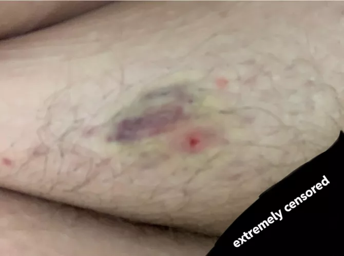 Poppers, beware! Had an ingrown hair on my coochie and apparently I squeezed too hard. Bruised, hurts to walk, extremely irritating. Be nice to your bodies, friends. NSFW even though you can’t see much. by tanglewoodtree