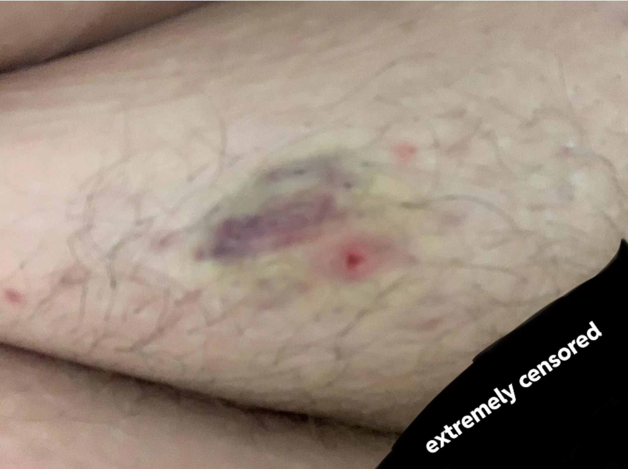 Poppers, beware! Had an ingrown hair on my coochie and apparently I squeezed too hard. Bruised, hurts to walk, extremely irritating. Be nice to your bodies, friends. NSFW even though you can’t see much. posted by tanglewoodtree