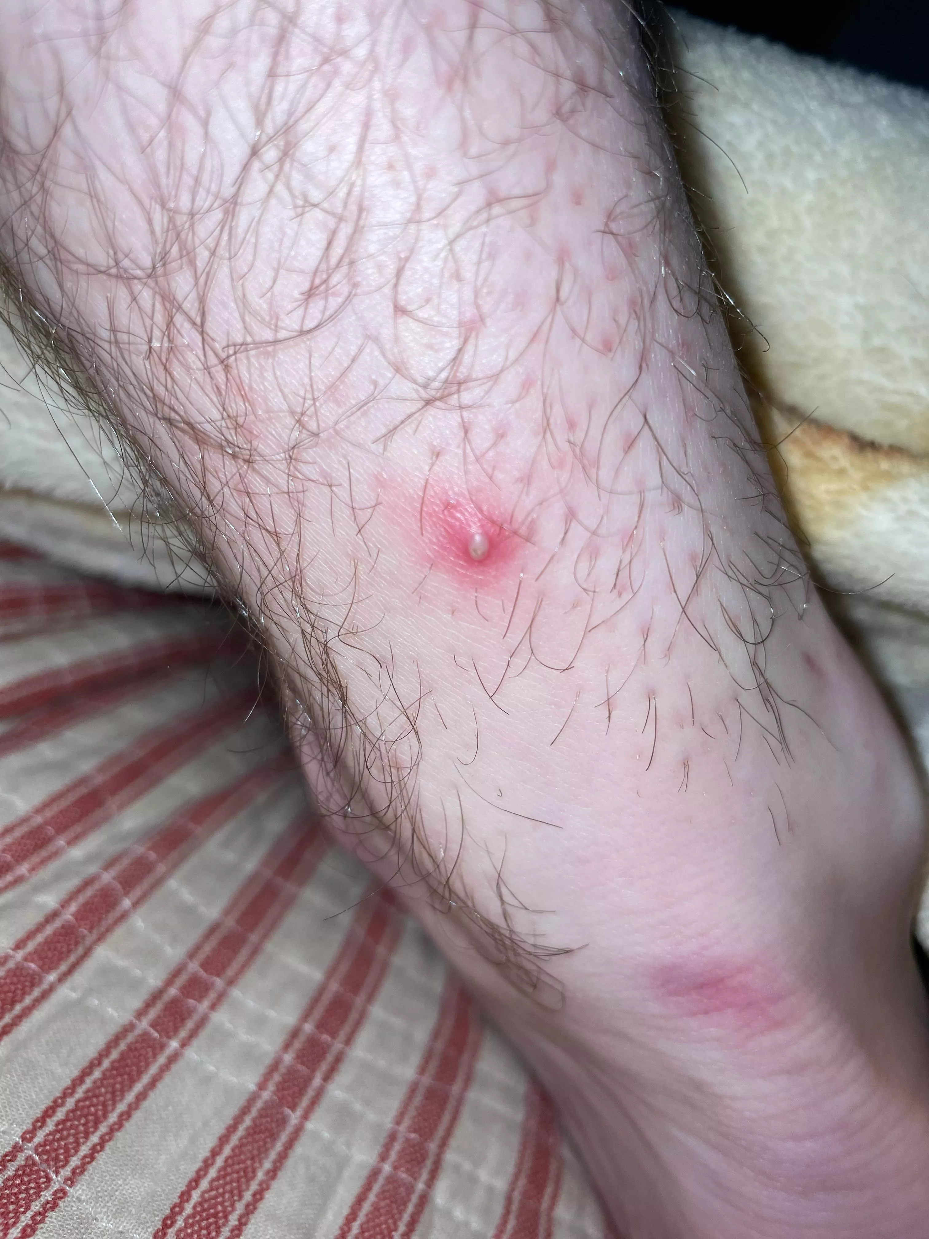 Pretty excited to rid this of my leg posted by dogbarkMark