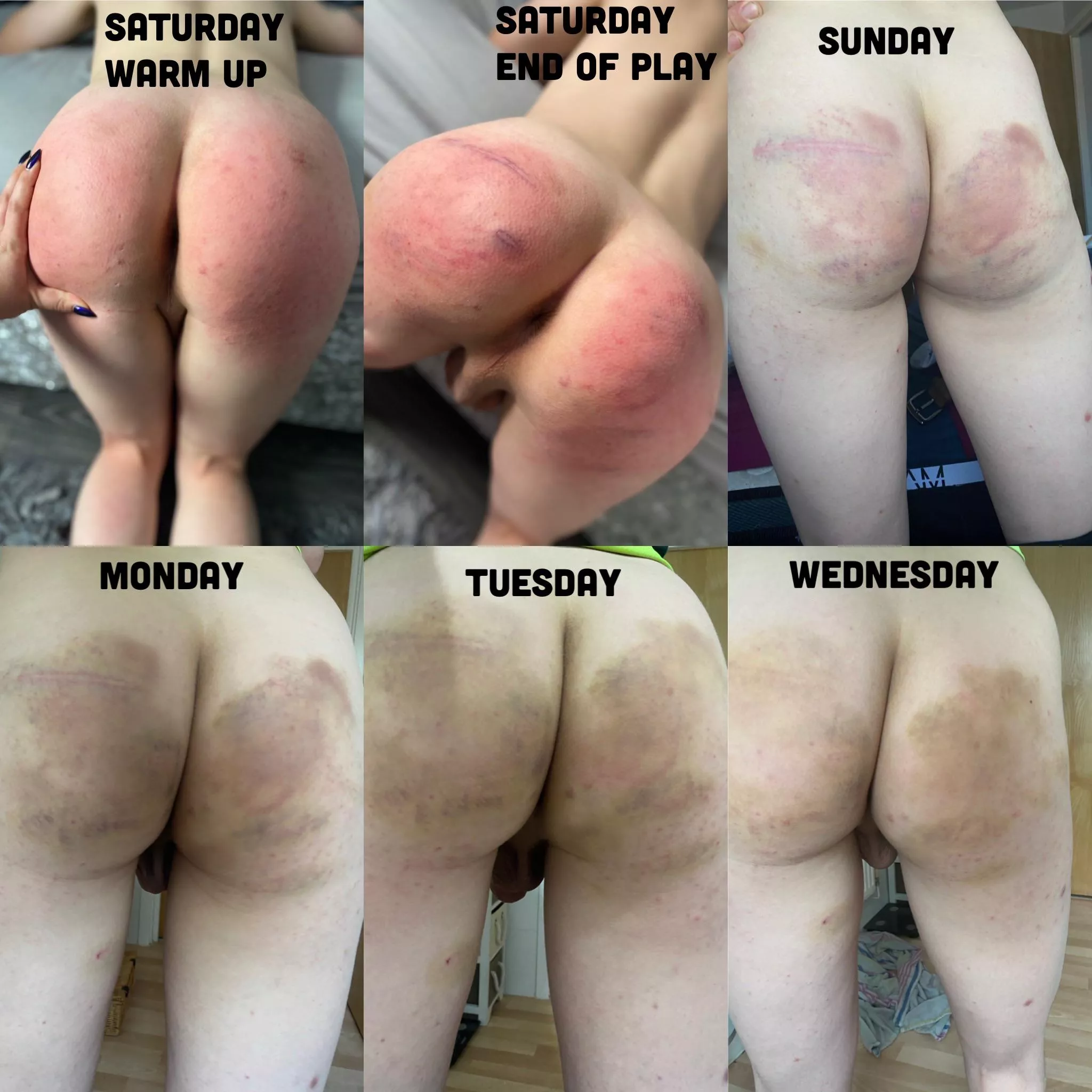 Progression of bruising from an amazing impact session with my Dutchess. A very tender but incredibly happy puppy 🖤😈 posted by DutchessCollaredPup