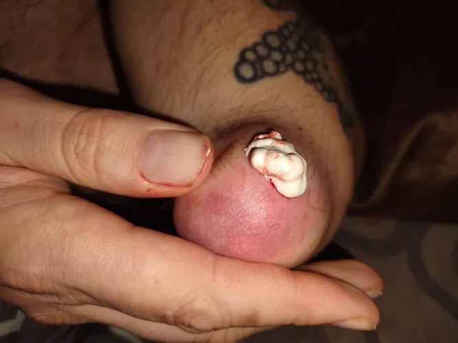 Punctured tophi on an elbow by Lady_Ramos