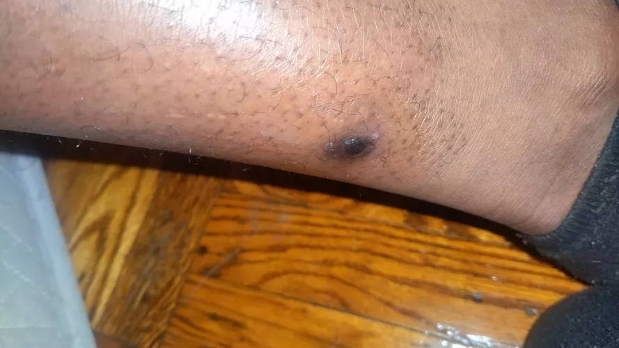 Random update:The meds/cream aren't really working.. here what it looks like right now by caseyscolumbusss