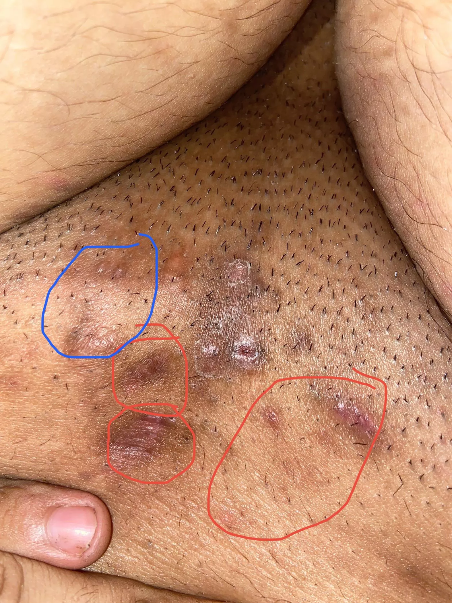 Red are the scars from popping and the Blue is a new one forming it just happens in that area posted by FanUnable9149