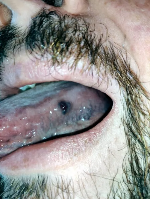Red lump on tongue - very rare, begign Masson's tumor. Surgically removed later by nimnox